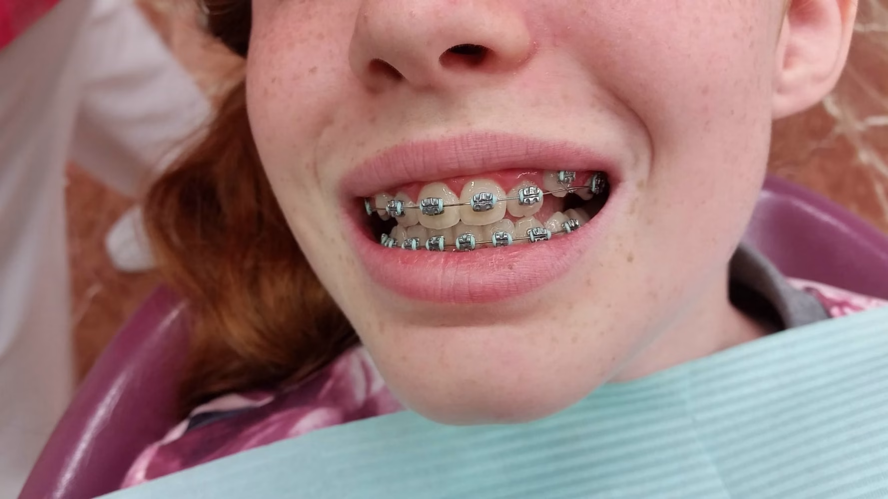 El precio de los brackets varía según los accesorios personalizados que incluya el tratamiento